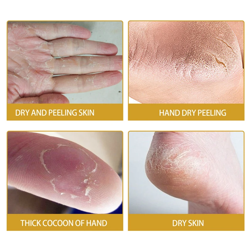 EELHOE cracked skin banana repair cream hand feet moisturizing heel cleft palate crack bleeding dry itches repairing cream