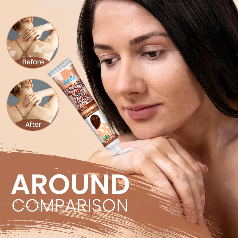 Vitiligo Safe and Effective Treatment Cream White Spot Ointment Flower Spot Sweat Purpura Skin Topical Ointment