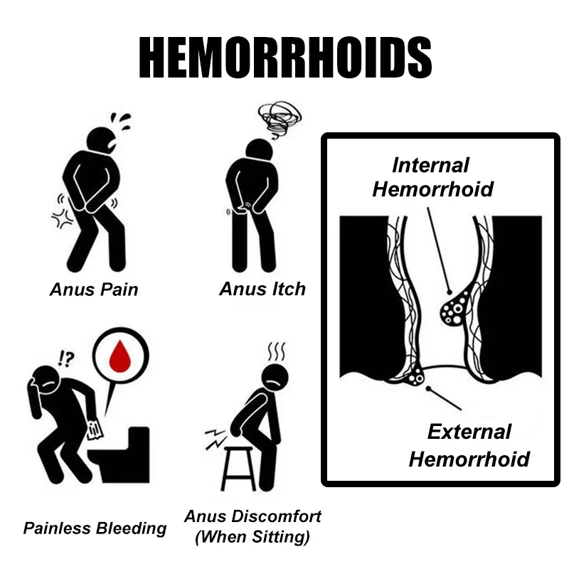 Medical Hemorrhoid Ointment Relieve Hemorrhoid Pain Anal Bleeding Swelling Anal Fissure Hemorrhoids Bacteriostatic Cream KanyeHB