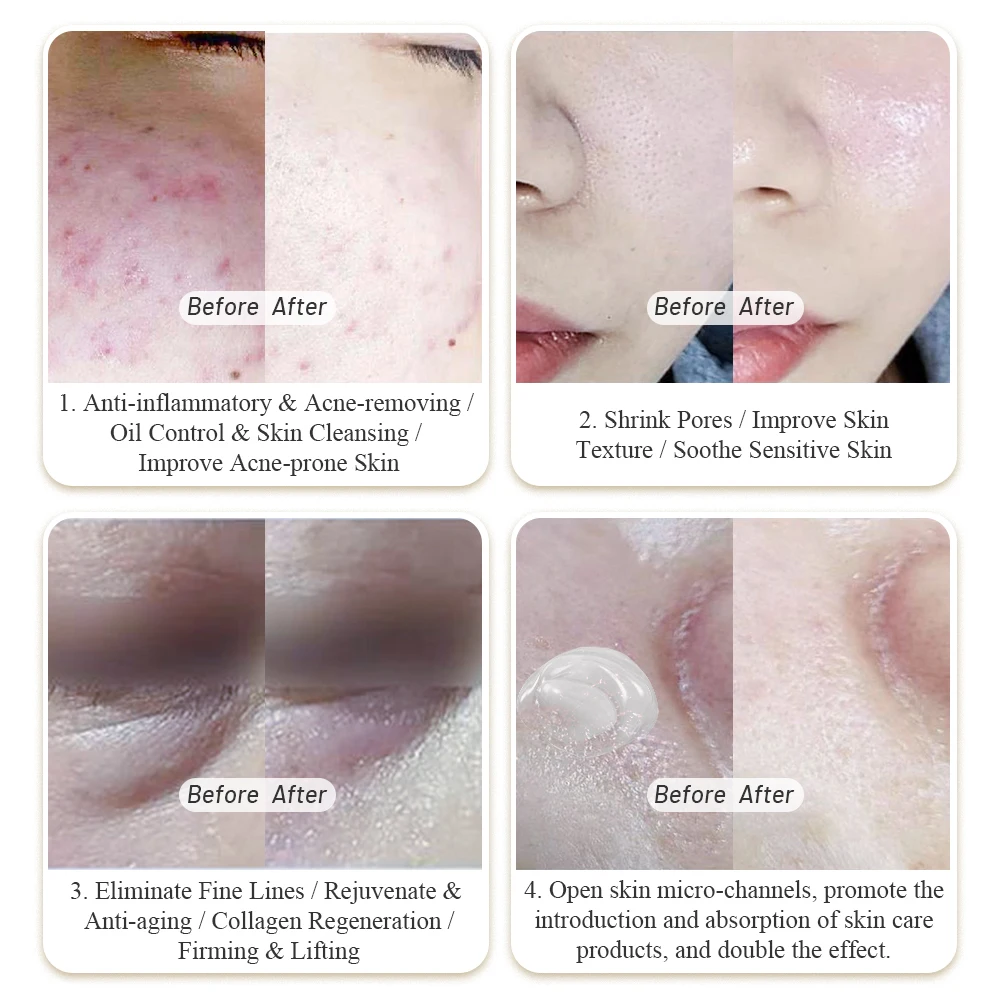 2022 New design skin tightening and Rejuvenation/skin tag removal/ fractional Plasma laser machine with low price