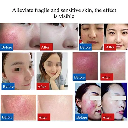 
Lyophilized Powder Acne Scar removal Serum Anti-wrinkles Organic and Natural Ingredients 