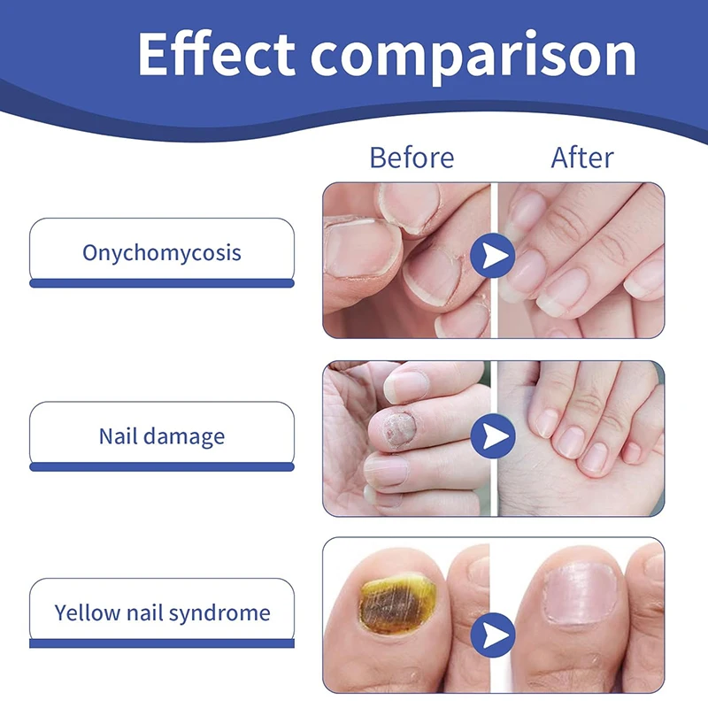 Restores Healthy Appearance Nighttime Renewal Fungal  Overnight Nail Treatment Patches for Nail Fungus Damage