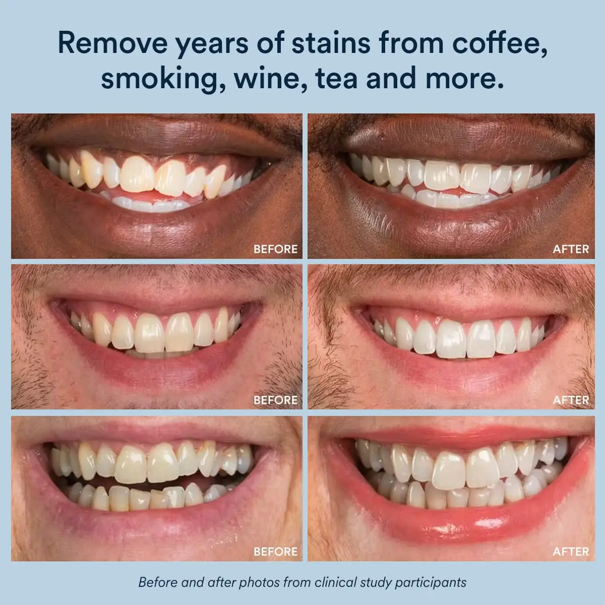 Oem Private Label Dental White strips,Teeth Whitening Dry Strips