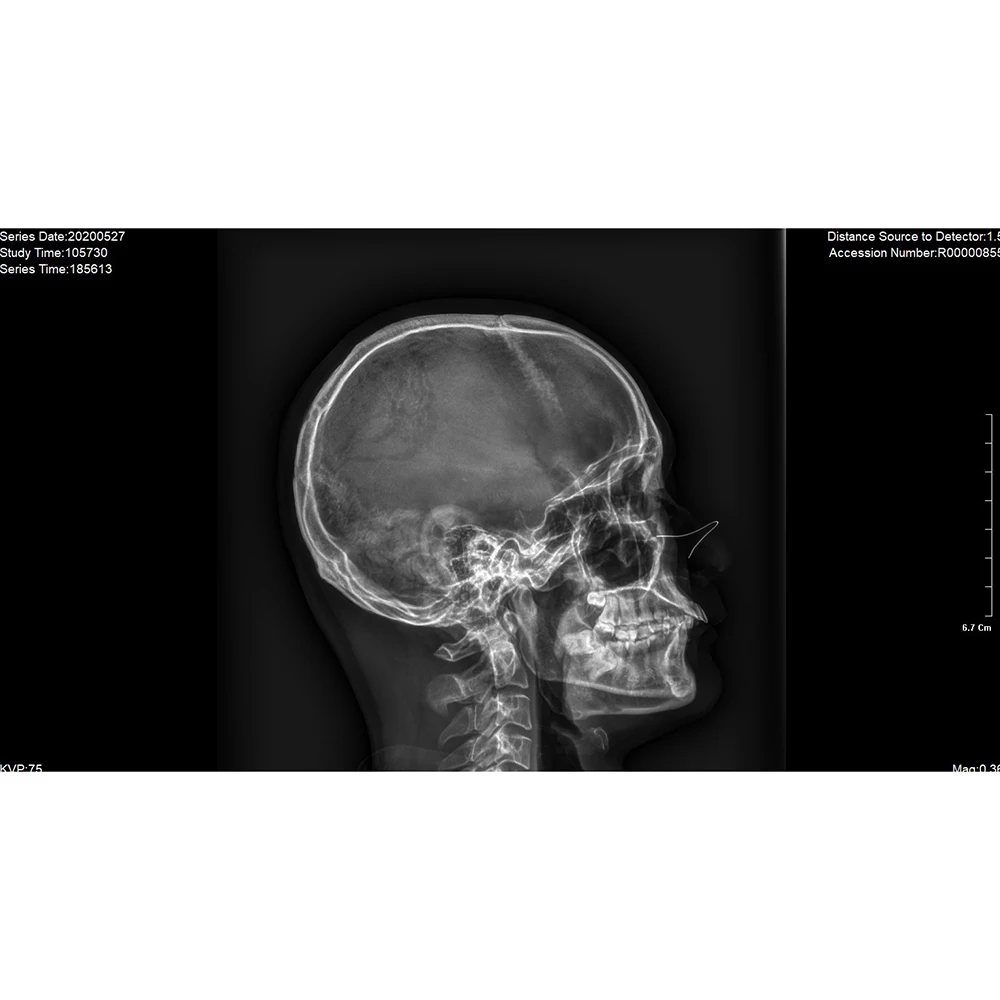 2024 Factory Price 17*17 Inch Wireless Digital X-ray DR Flat Panel Detector For Human Veterinary