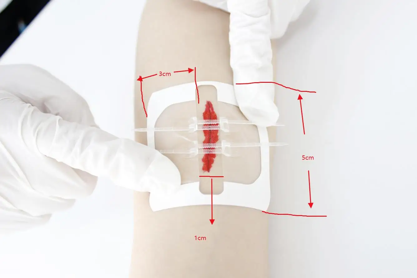 Transparent PE wound zipper skin suture zipstitch