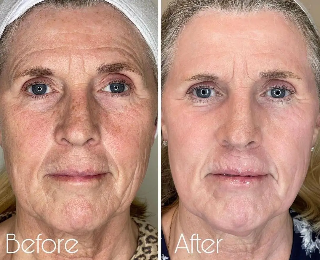 510K Number Approved Medical Clinic Use Co2 Fractional Laser Machine Skin Resurfacing Anti Wrinkle Stretch Mark Removal Machine