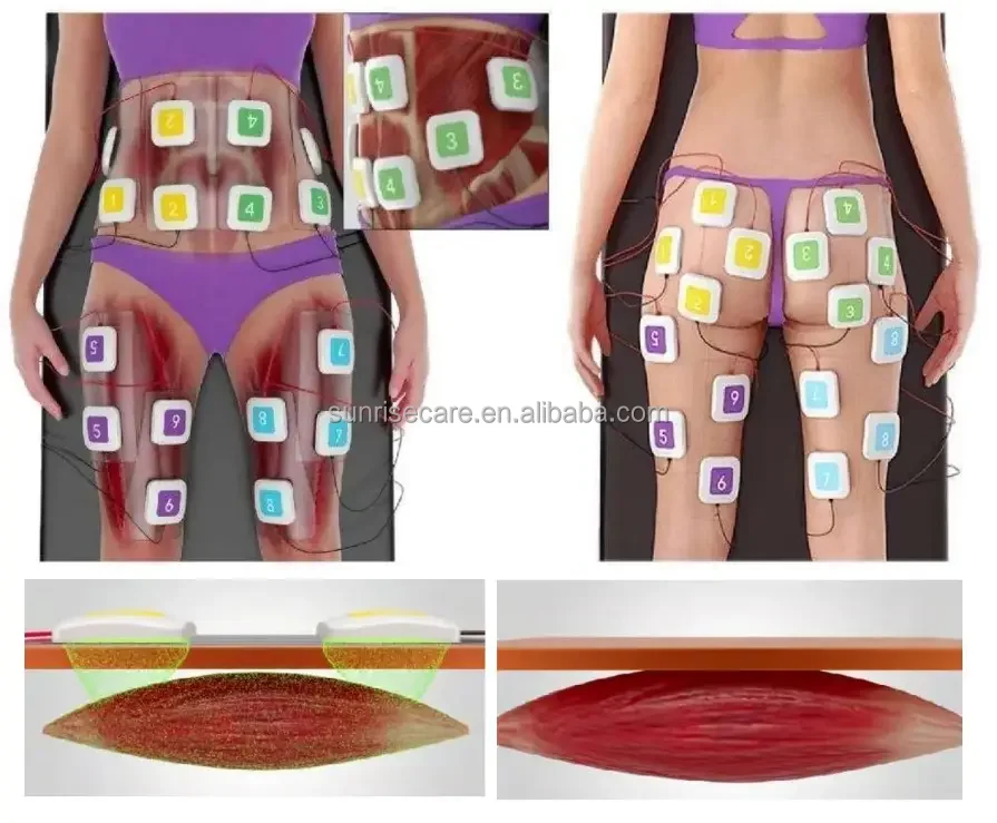 Аппарат для электростимуляции