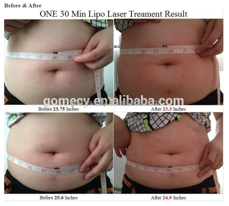 GOMECY 5 Wavelength Far Infrared 5D Lipo Laser Belt For Pain Relief And Body Contouring