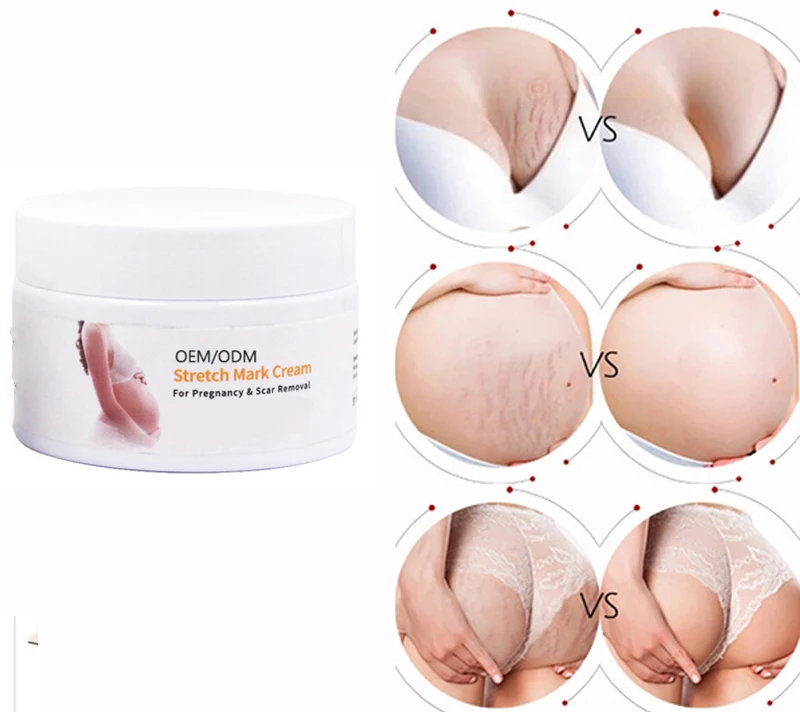 free shipping  stretch marks removal cream all skin stretch mark cream thailand quick and fastest cream for stretch marks