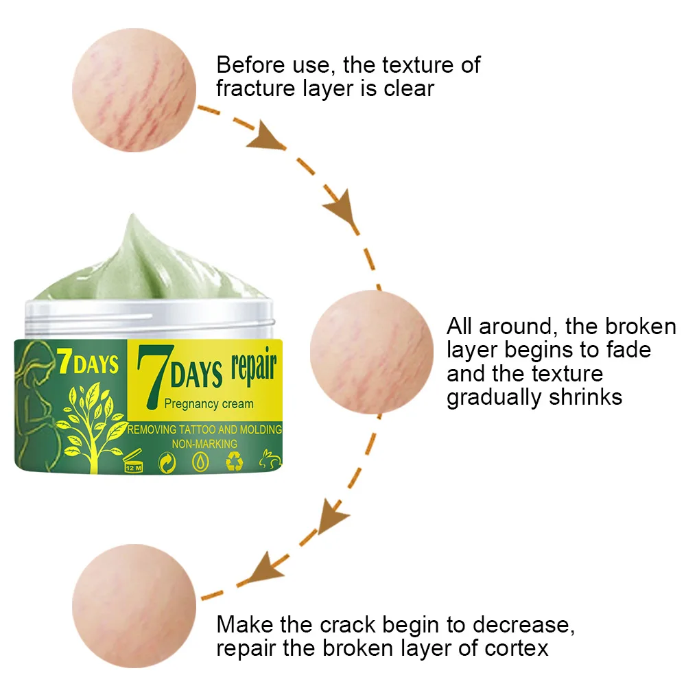 Natural Mild Non-irritating Remove Stretch Mark Cream for Pregnancy Repair Scar Slack Line Abdomen Stretch Marks Cream