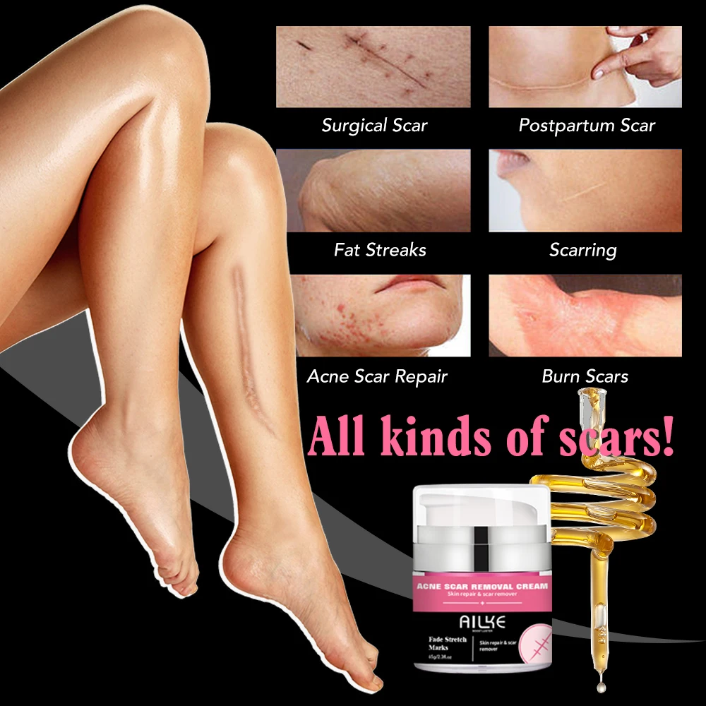 Strong Effective Acne Scar Removal Cream Smoothing Firming New Scars Stretch Marks Pimples Treatment Cream