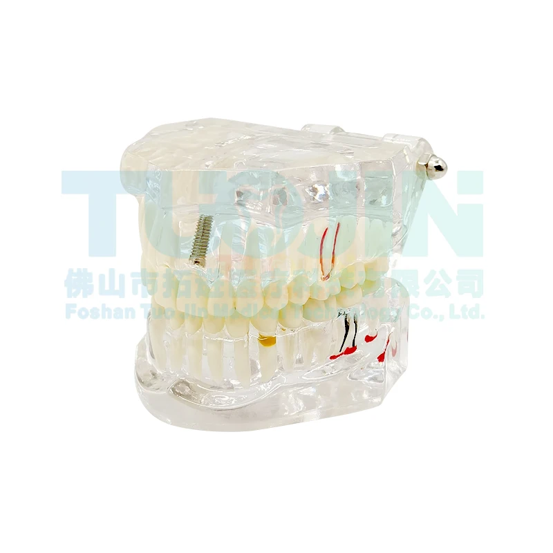 Transparent Disease Teeth Model Adult Standard Transparent Dental Implant Tooth Model Dentist Demonstration For Dentist Medical