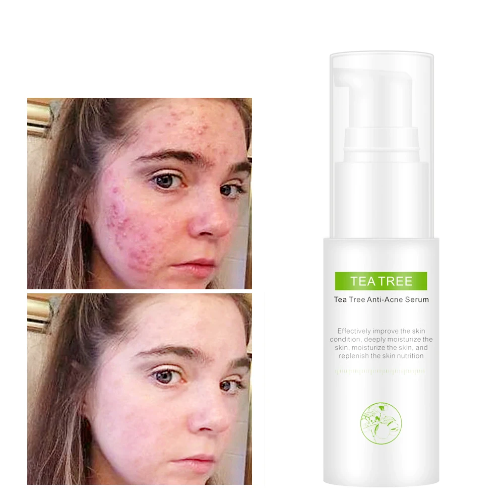 Own brand organic herbal tea tree essence acne treatment toner soothing and moisturizing facial beauty toner
