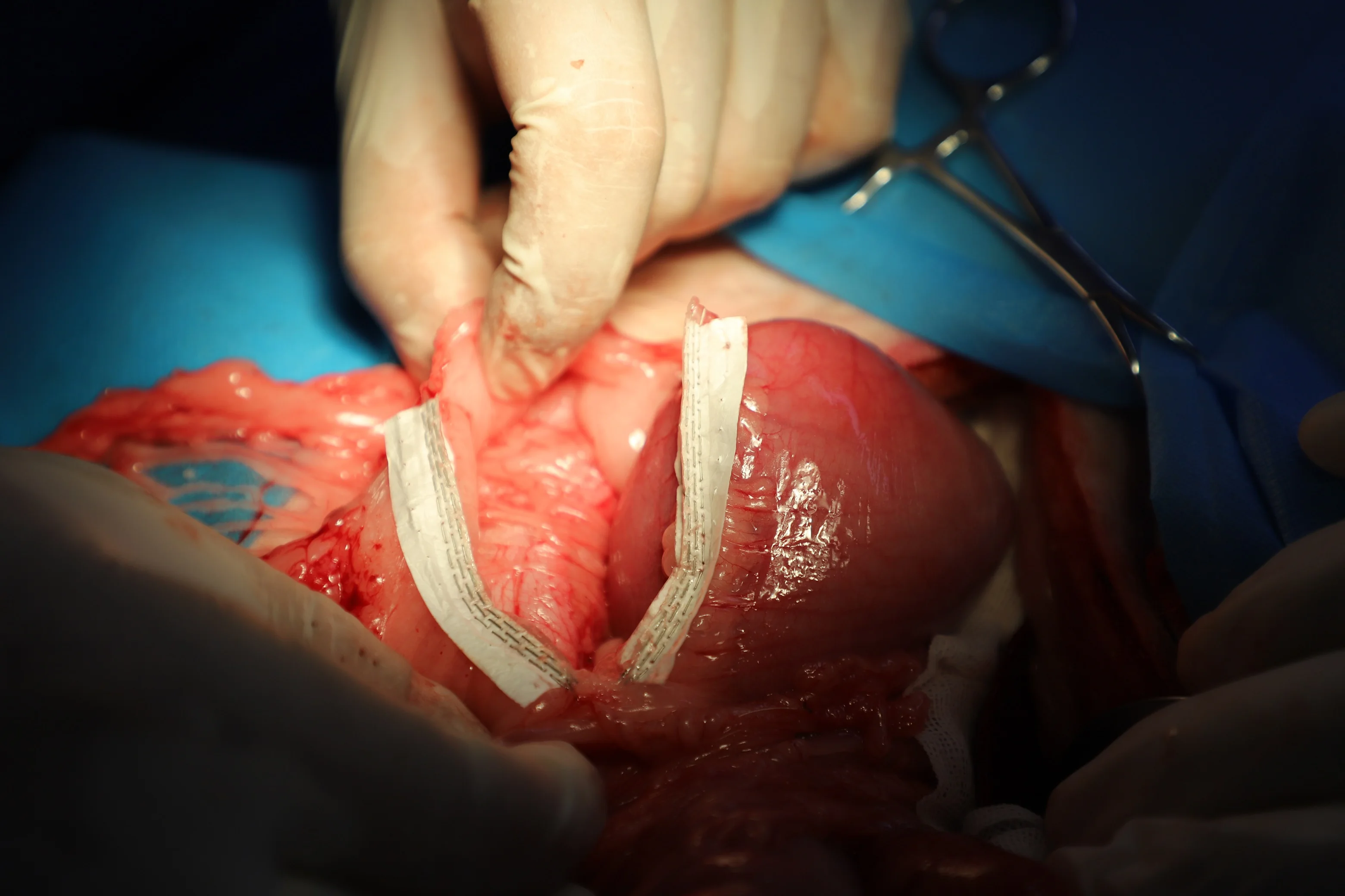 disposable endo articulating staplers New stapler endoscopic New Staple Line reinforcement