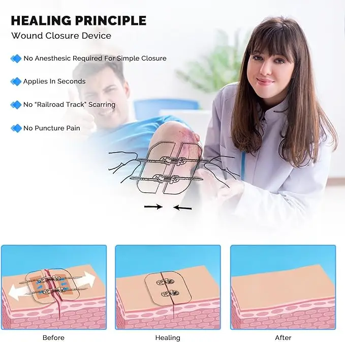 Extra Large Steri Strips Wound Closure Device, Waterproof Butterfly Wound Closure Strips