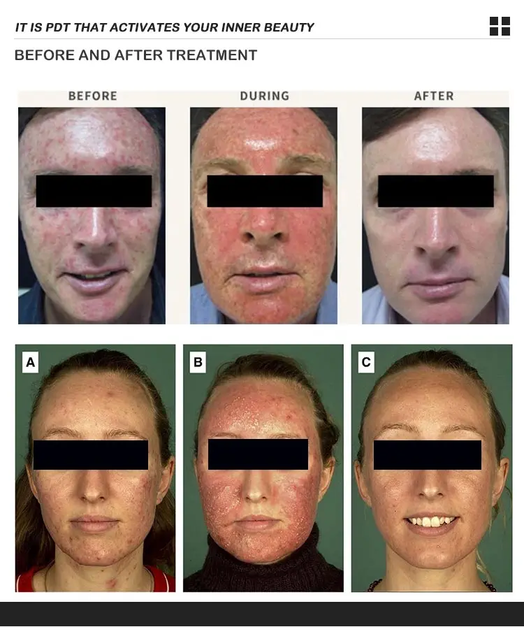 2024 hot product 7 colors mascara led light therapy  PDT therapy facial whitening LED pdt machine