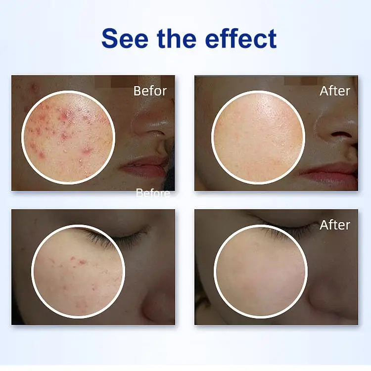 2023 Best Plasma Acne Removal Tools Acne Treatment Machine Anti Aging Facial Beauty Equipment