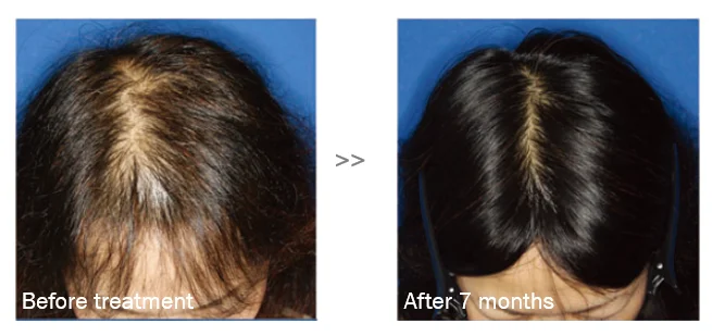 Professional meso therapy peptide hair growth ampoules for hair loss