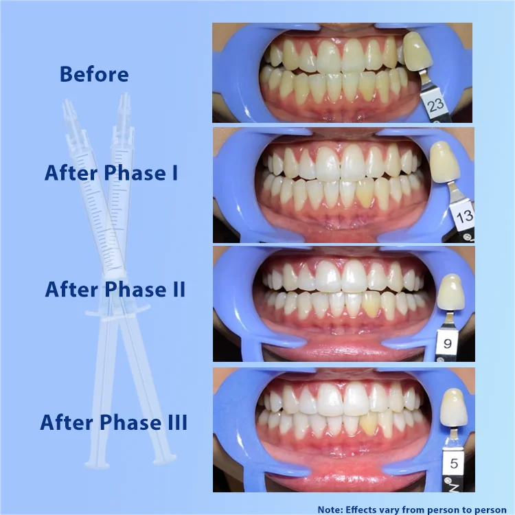 2 Ml Multi-Flavor Non Peroxide 16% 35%CP Carbamide Peroxide For Sensitive Gel Syringes Wireless Teeth Whitening Kit