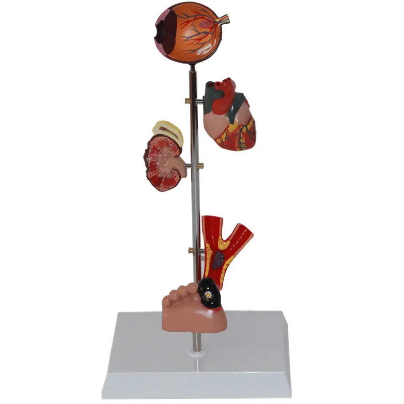 Mini Diabetes Type 2 Anatomical Organ Model Set- Eye, Heart, Kidney, Artery, Foot
