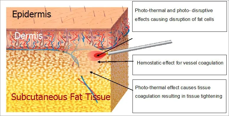 laser liposuction surgery mini-invasive laser surgery melting fat slimming lipolysis laser