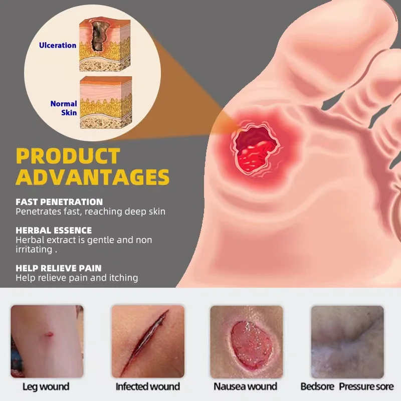 Best Seller Bedsore Treatment Cream Removal Rot Myogenic Pressure Sores Ointment Wound Healing Anti-infection Cream