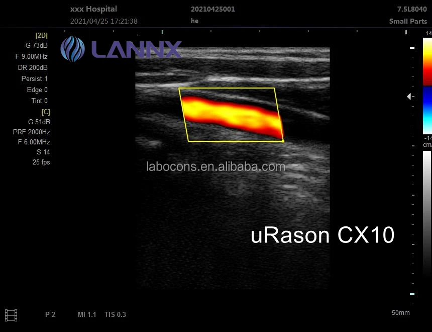 LANNX uRason CX10 Most popular ultrasonic Portable Hand Ultrasound Color Doppler Imaging Diagnostic Ultrasound Equipment