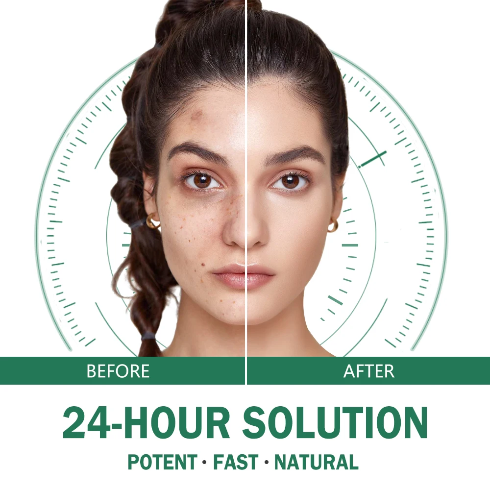 GMP Organic Acne Treatment Acne Deep Scar Removal Face Cream Female Skin Lightening Dark Sport Corrector Kinds Skin Care Adults