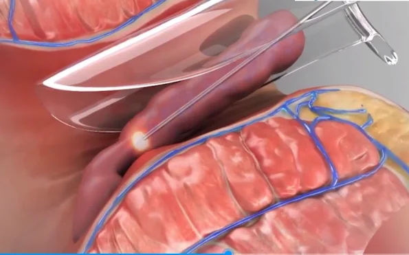 Professional infrared physiotherapy 980nm diode hemorrhoids laser device for proctology