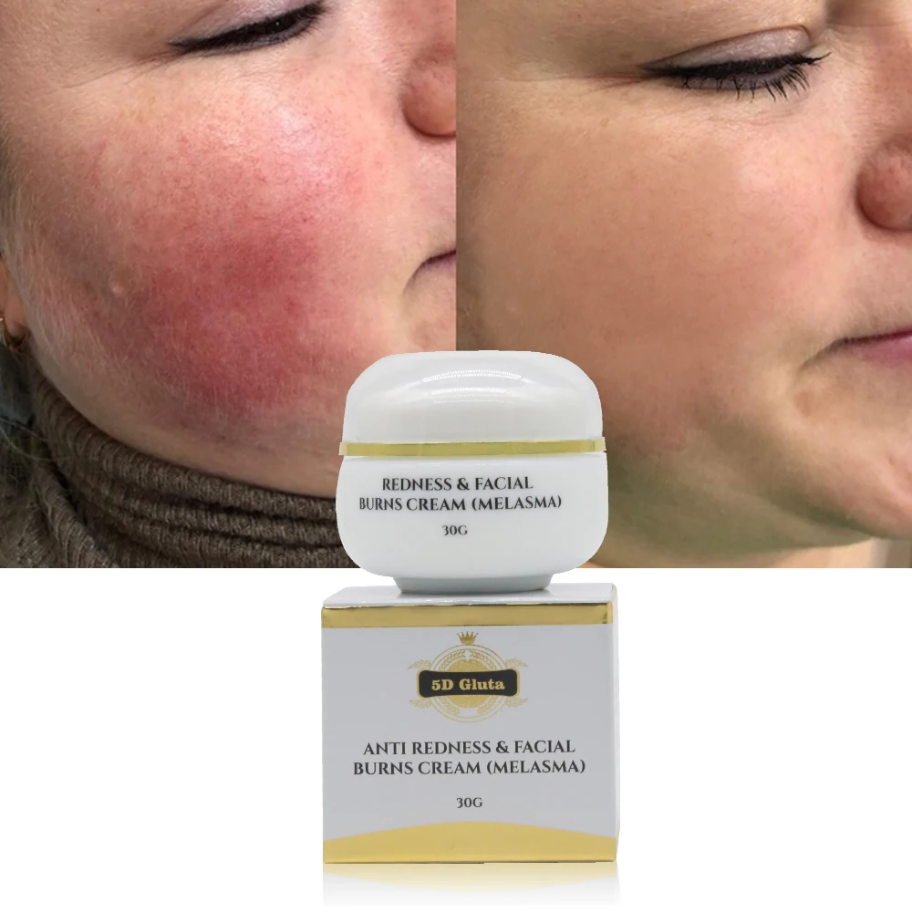 Strong Effective Skin Lightening Reduce Redness Burn Face Face Whitening Freckle Cream Remove Melasma Fade Dark