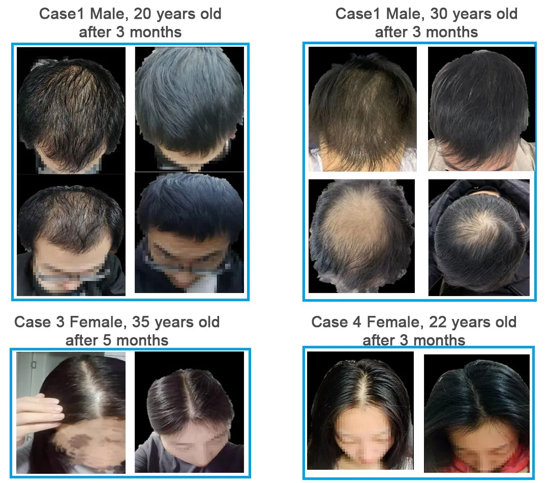 LLLT technology Diode Laser Hair Regrowth Therapy Machine Stimulate Hair Growth Machine Extension