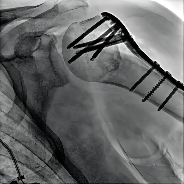 Oncology interventional treatment medical x ray c arm system