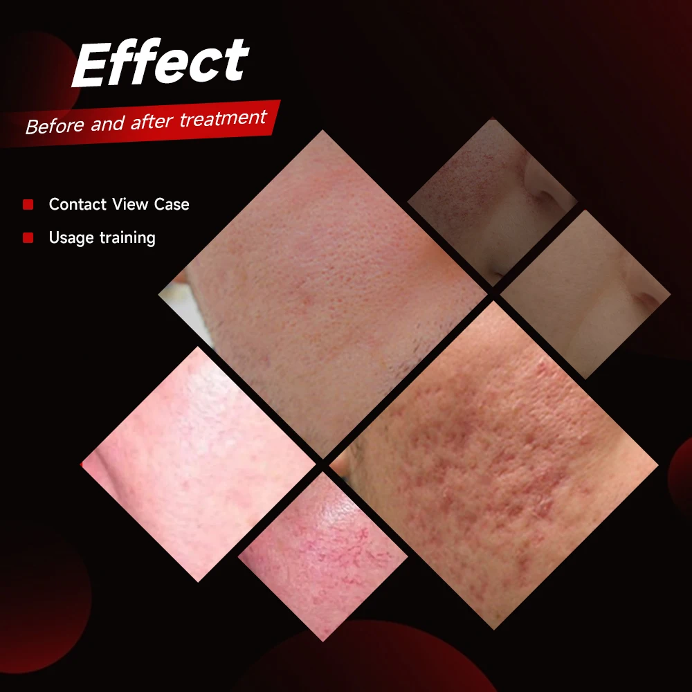 2024 latest hot-sale Laser Co2 Fractional/  Fractional Co2 Laser 980nm RF Tube Vaginal Tightening machine laser skin resurfacing