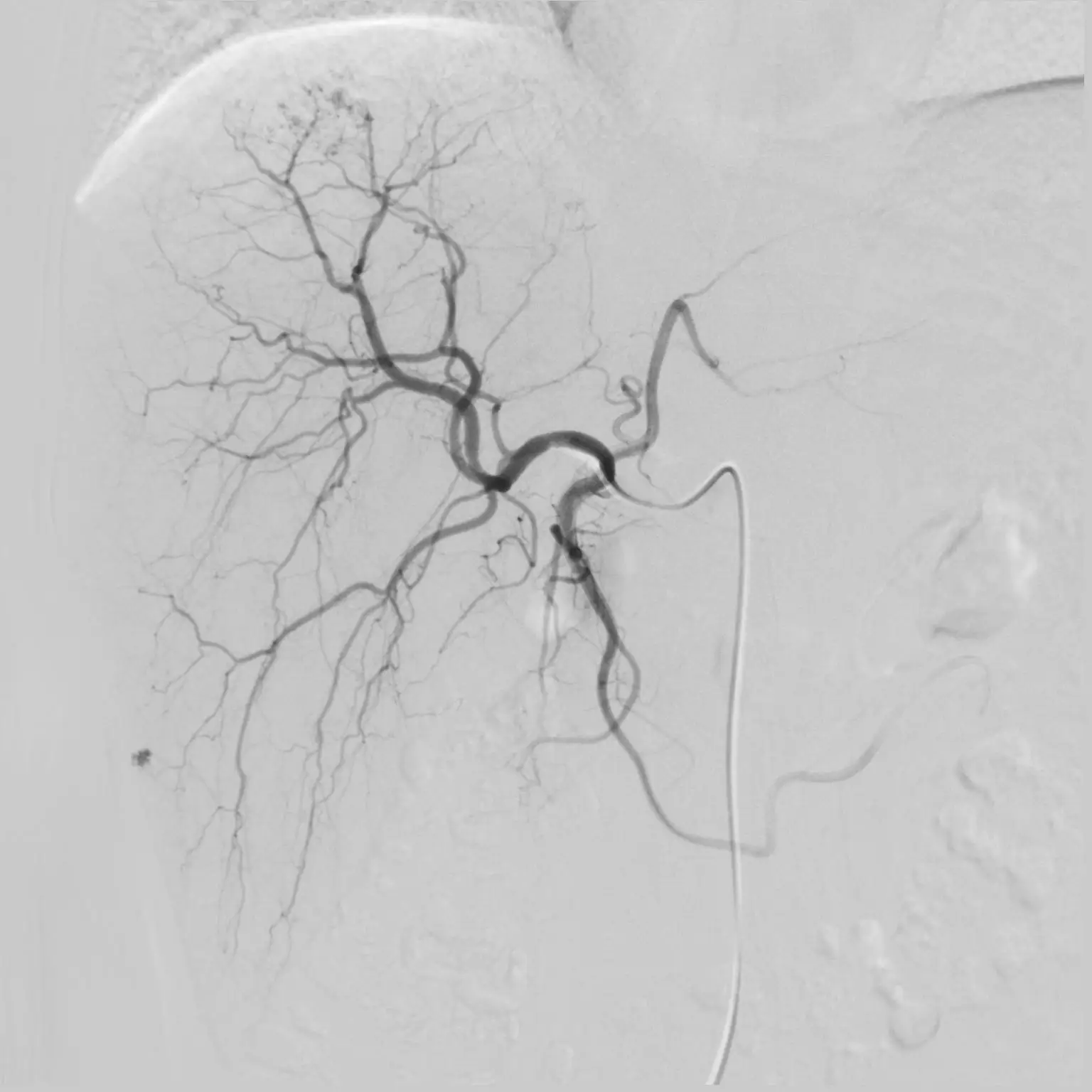 100 kw Imaging medical CE Approved C-arm X-Ray Fluoroscopy Radiology Angiography Machine with Liquid Metal Bearing X Ray Tube