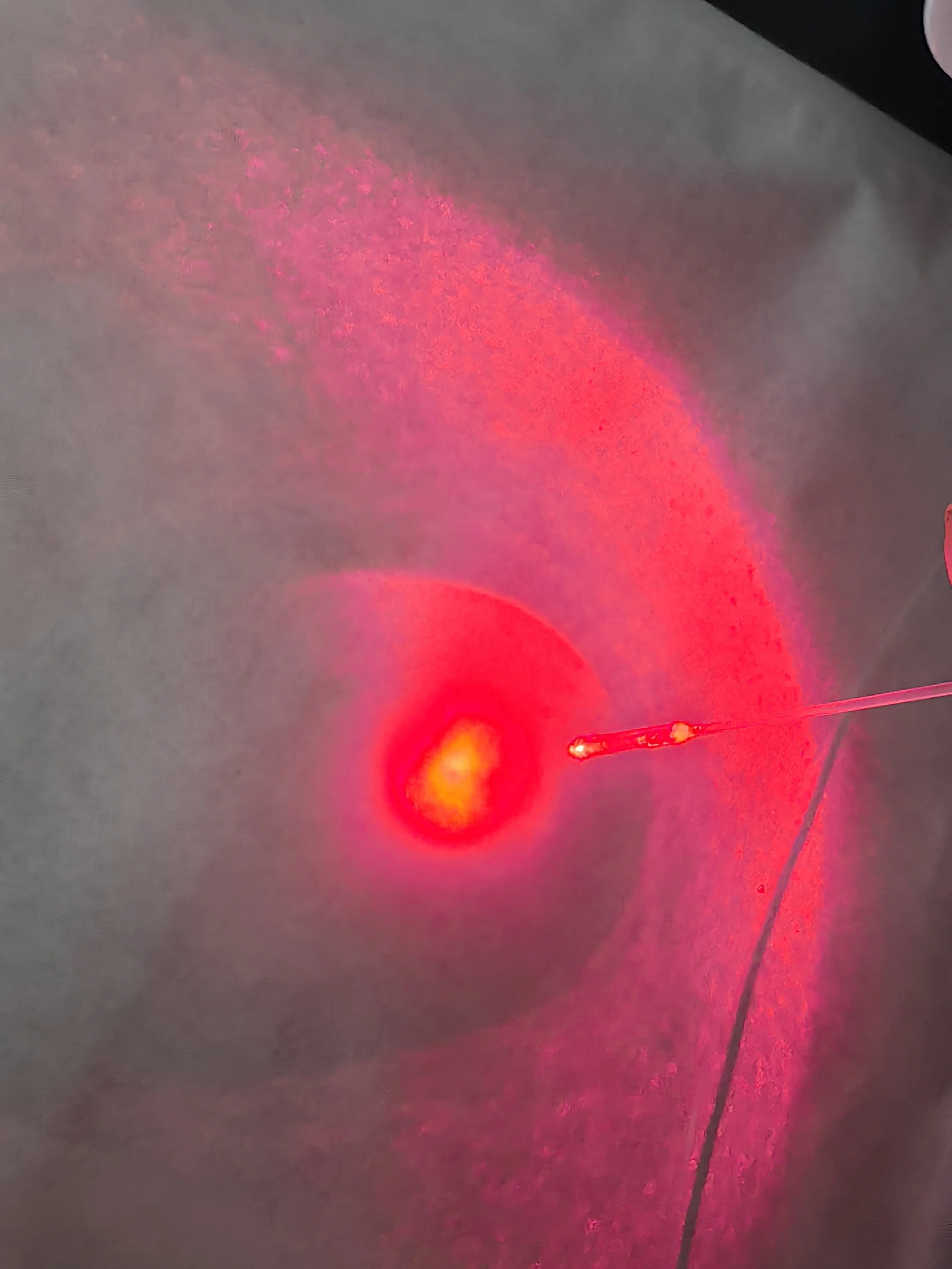 Surgery no Bleeding 1470nm Proctology Hemorrhodis Fistula Laser Sugery Machine With 600um Radial Fiber 600um Conical Fiber