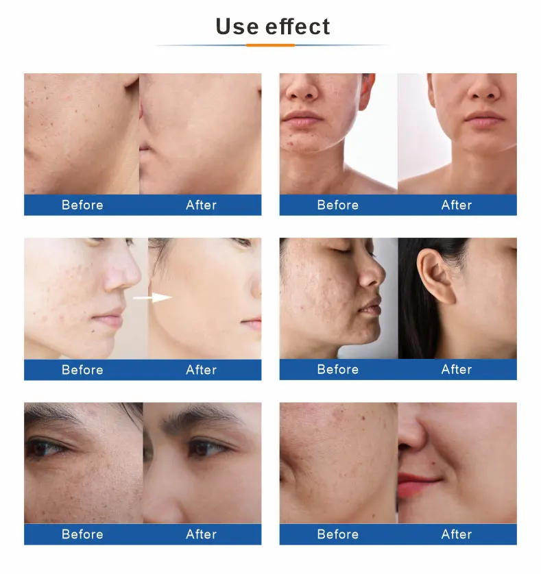 2024 4 in 1 Oxygen jet Multifunction water oxygen jetpeel oxygen jet peel facial machine