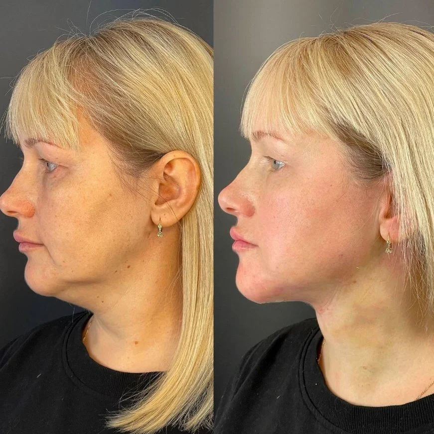 Medical Surgery Lipo Laser Device 980 1470nm Diode Laser Firming Face Endolaser Body Shaping Liposuction Machine