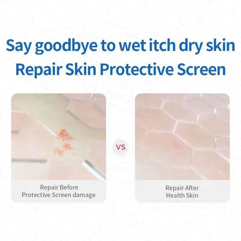 V eczema cream for kids toddlers in face scalp adults from stress