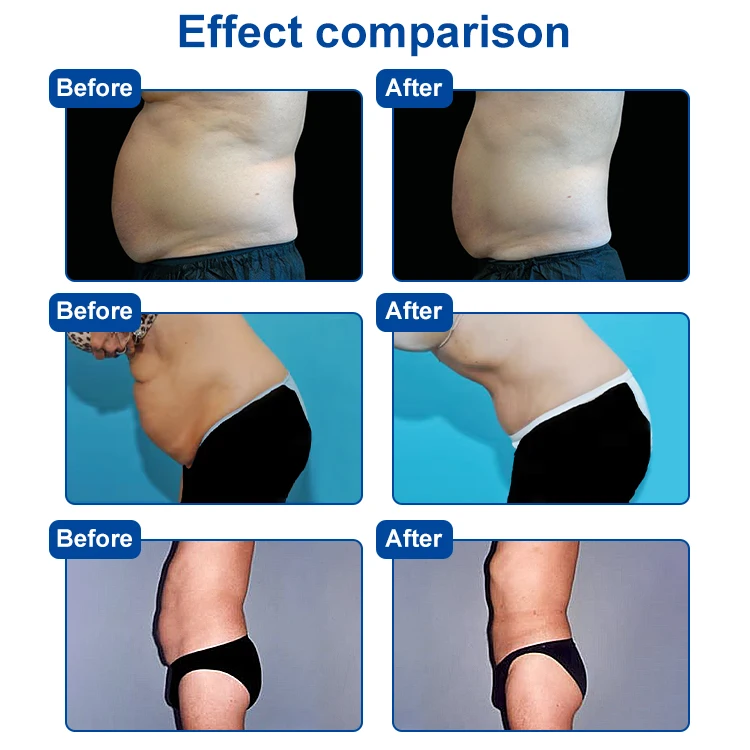 Best Selective radio frequency weight loss field Tuning real-time monitoring slim machine