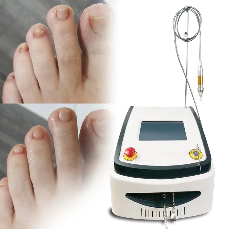 Portugal popular Diode laser high power 980nm 60w laser machine for onychomycosis/fungal toenails beauty center device
