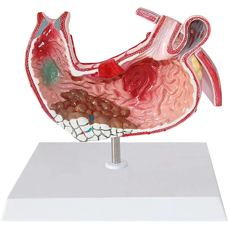 Anatomical Model Human Gastric Lesion Model Anatomy Pathological Model of Stomach
