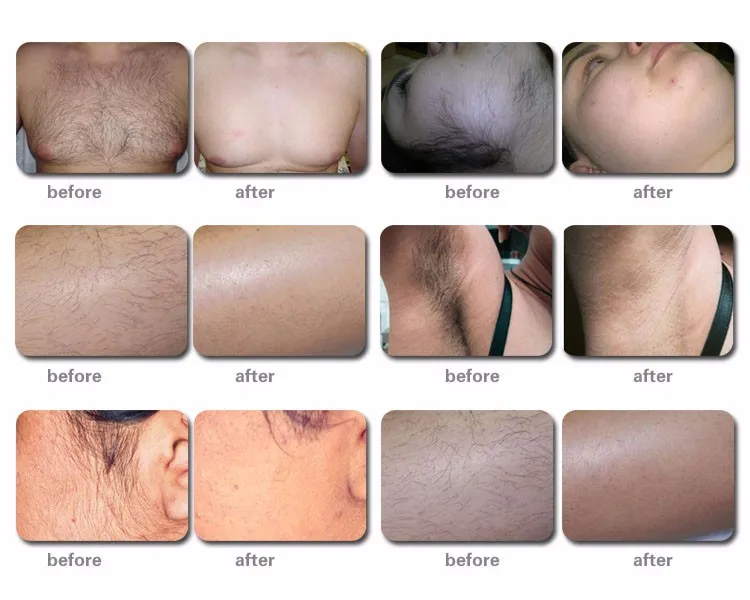 Diode Laser Hair Removal Machine 808nm Tri Wavelength  Spare Parts Handle Diode Ice Stationary Xl 24V