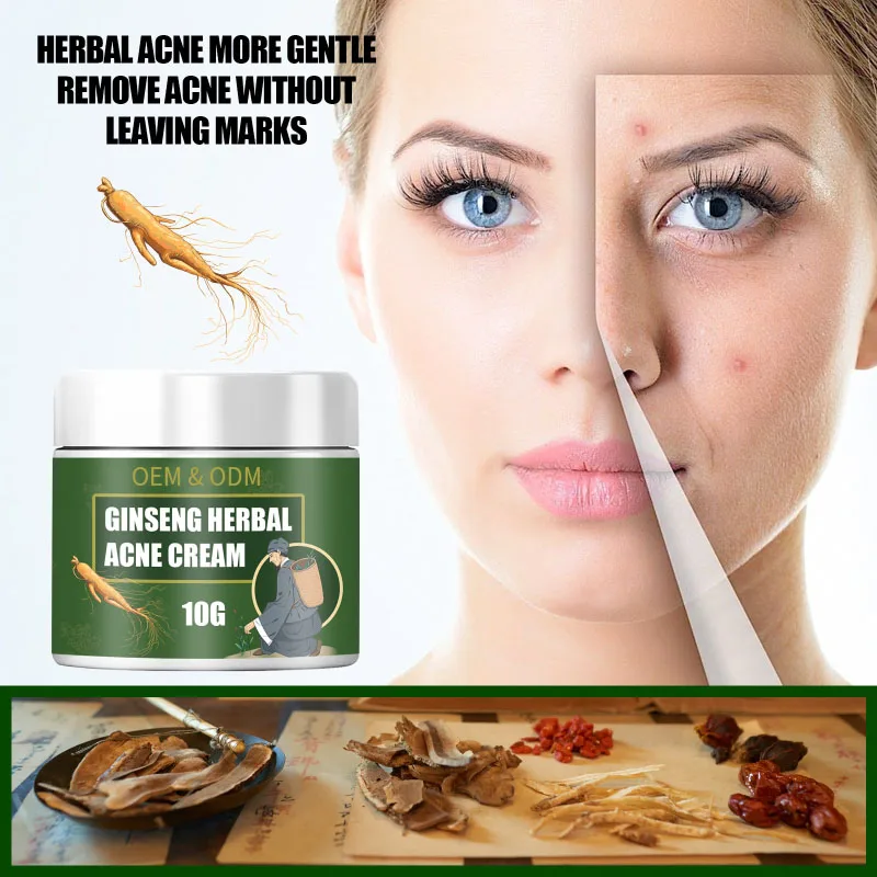 Facial Skin Care vitamin E Cream Anti-Acne  Acne Scar Removal Natural Herbal Extract Herbal Acne Removing Cream