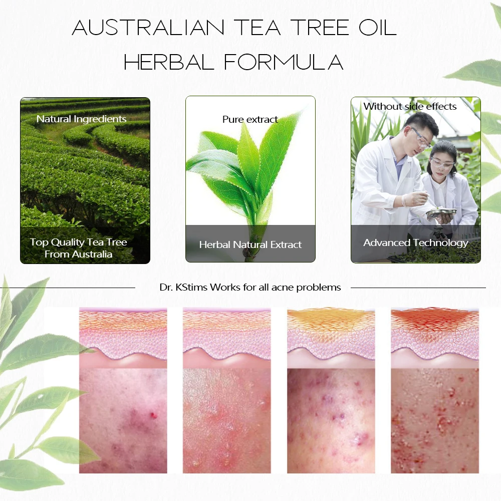 Best Herbal Acne Control Removing and Skin Lightening Face Cream For Acne with 20ml tube in Pakistan