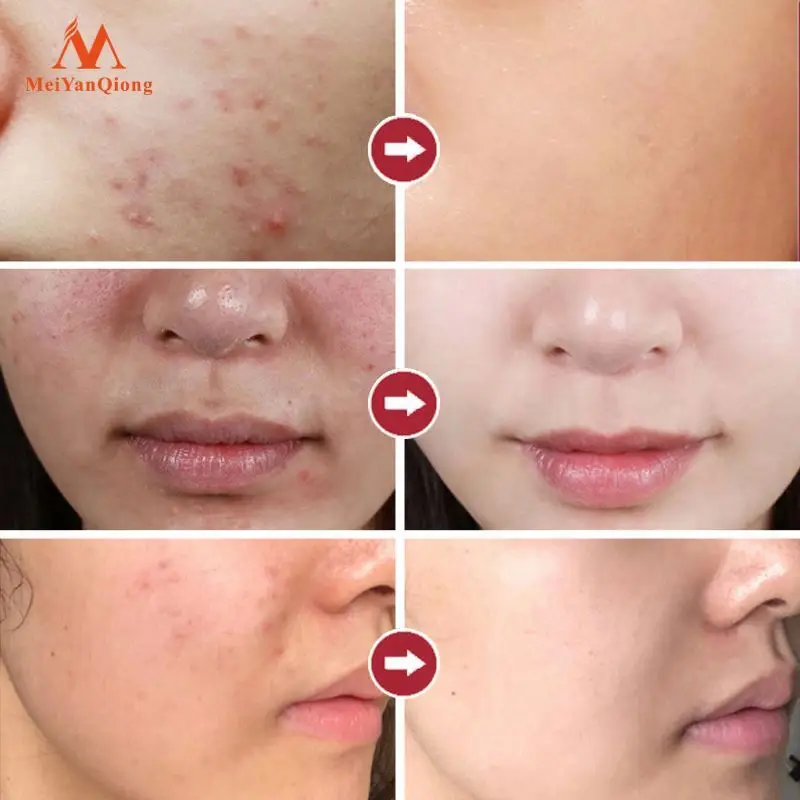 Volcanic Soil Facial Mask Acne Remove Blackhead Mite Propolis Face Treatment Repair Whitening Cream Skin Care Moisturizing