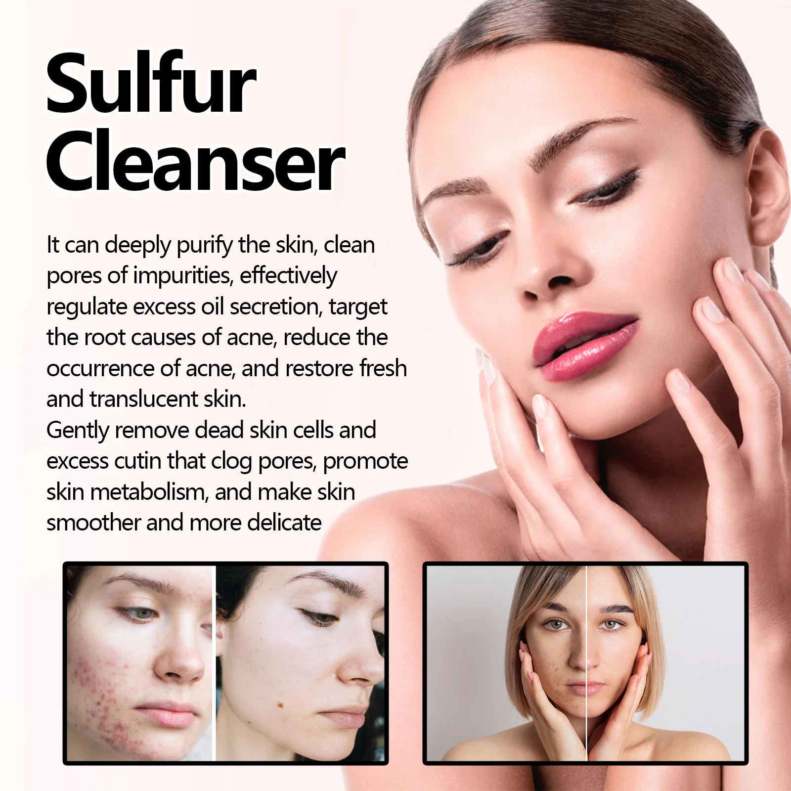 10% Sulfur Face Wash Facial Cleanser with Lemongrass Extract Seborrheic Dermatitis Breakouts Breakouts Relief for