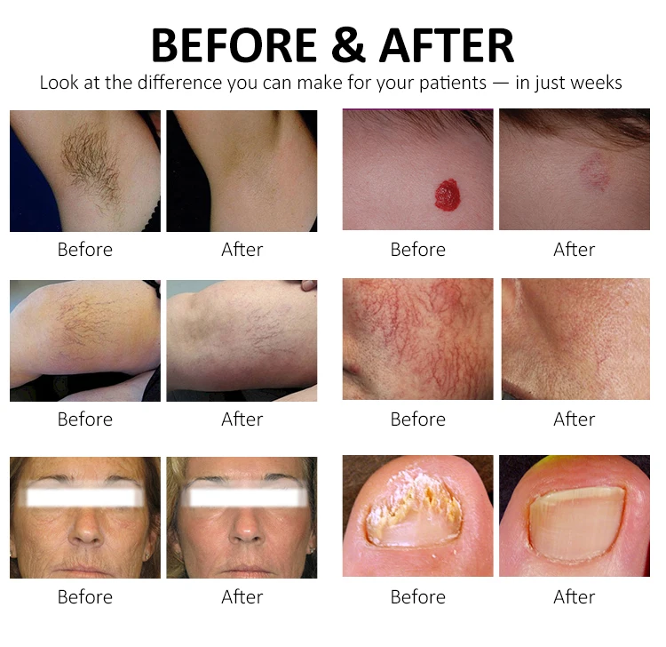 755nm Alex Laser 1064nm Long Pulse Nd Yag Hair Removal Alexandrite Laser Candle machine manufacturer price