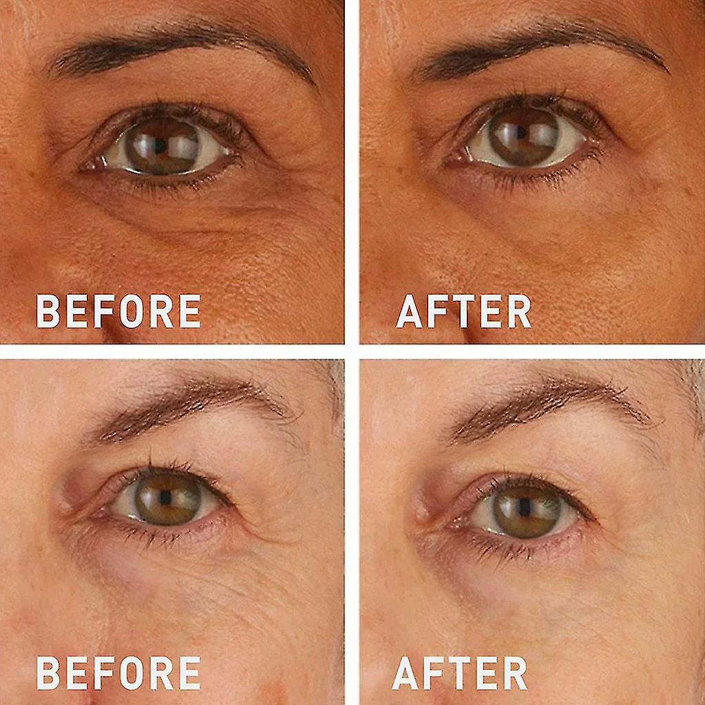 Low Price Custom High Quality Hyaluronic Acid Gel Microneedle Dissolving Under Eye Patch