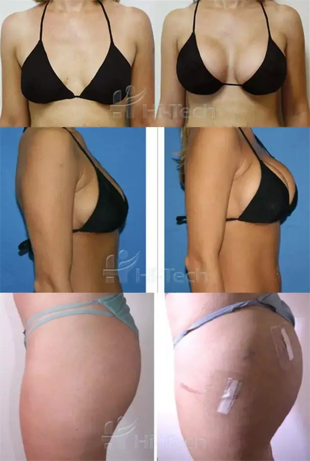 Hot Selling Charmost Dermal Filler Manufacturer Cross-linked Hyaluronic Acid Injection For Breast Buttocks Ass Enlargement