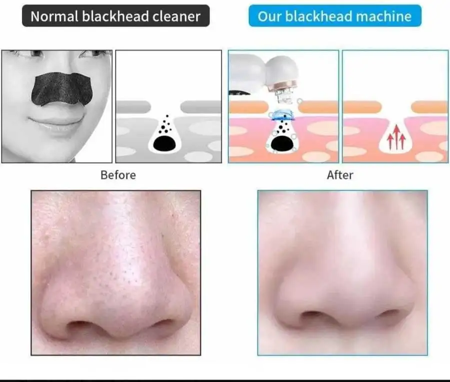 Face Vacuum Pore Cleaner Needle Acne Pimple Removal Black dot Nose Mask Deep Facial Cleaning Small Bubble Blackhead Remover.jpg